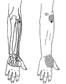 trigger points and referred pain pattern in the extensor muscles of the forearm