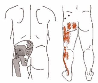 Diagram, Gluteus minimus trigger points and combined trigger point patterns